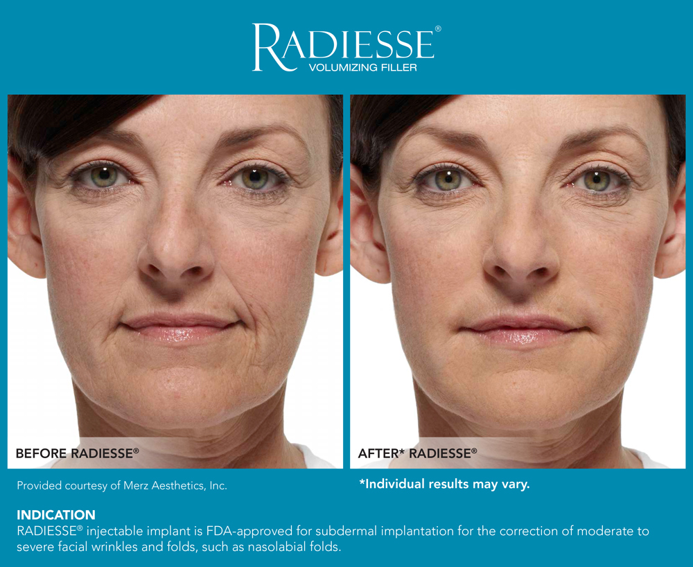 Smooth those lines with RADIESSE®