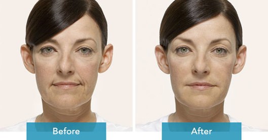 What Radiesse® Can Do for You!
